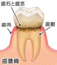 歯と歯ぐきの間に歯石や歯垢が溜まっている状態