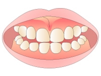 歯ぐきの黒ずみ除去