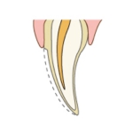 歯の表面を薄く削ります